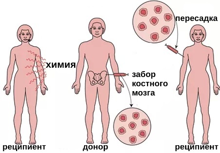 Leukemia. Symptoms in adults, children, blood test, treatment with folk remedies, drugs