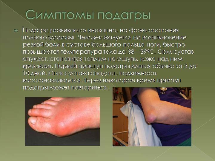 Salt deposition in the foot: treatment and symptoms, prevention methods and causes