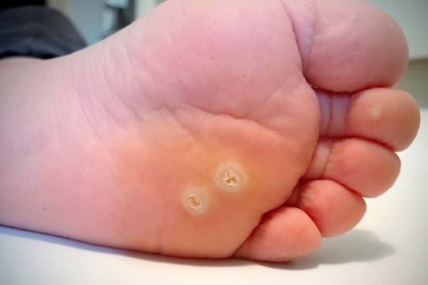 Shipitsa on foot. How to get rid of, photo, treatment in children, adults at home, laser removal, liquid nitrogen
