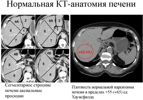 Segmentos de hígado en cortes de ultrasonido, tomografía computarizada, resonancia magnética. Esquema, foto