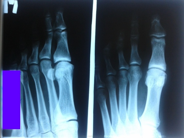 El dedo gordo del pie duele. Causas, articulaciones, uñas, huesos, almohadillas al caminar.