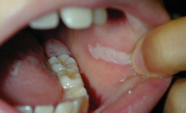 Leucoplasia de la cavidad bucal. Foto, diagnóstico diferencial