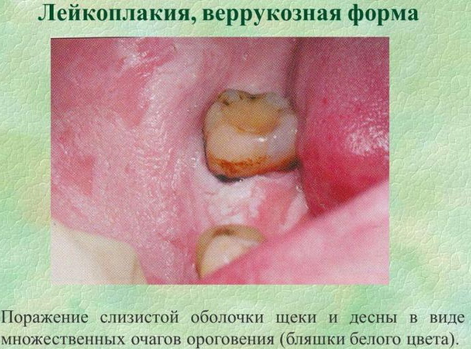 Leukoplakia of the oral cavity. Photo, differential diagnostics