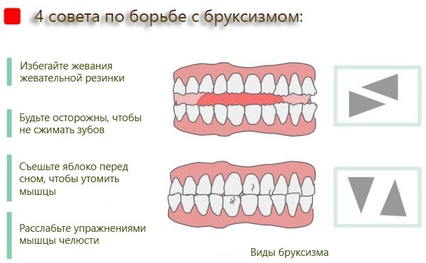 Sådan indsætter implantatet tand. Typer, pris, hvis, som er kommet til skade, anmeldelser