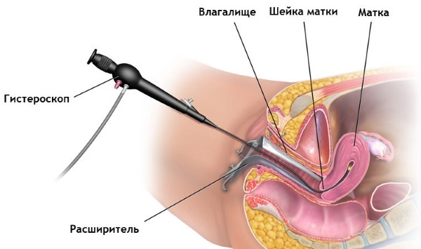 Office hysteroscopy. What is it in gynecology, is it painful to remove a polyp