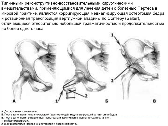 Síndrome de pinzamiento de la articulación de la cadera. Síntomas, signos, tratamiento.