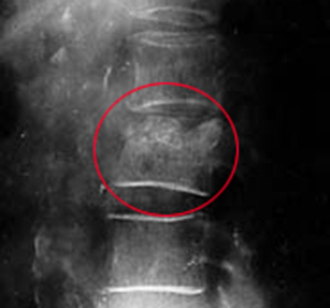 tuberculosis de los huesos de la columna vertebral en rayos X