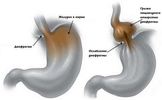 Hernia of the esophageal opening of the diaphragm