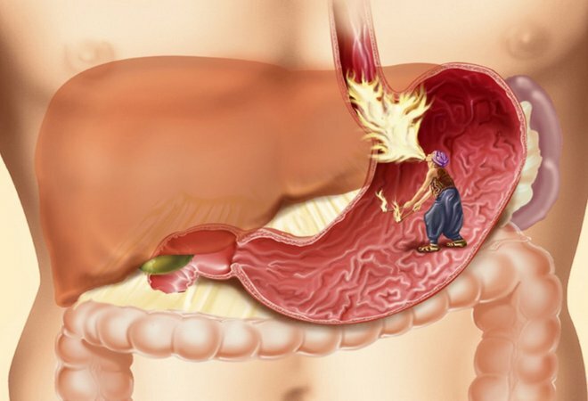 Os sintomas da úlcera gástrica