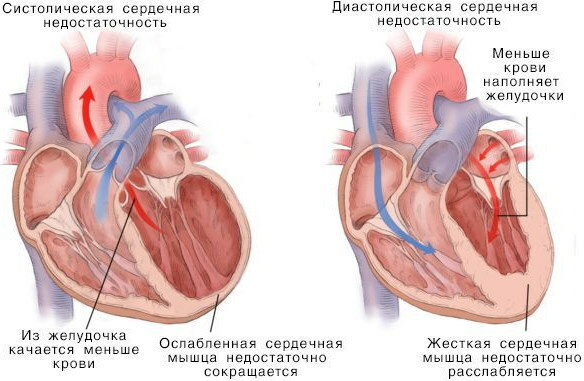 Insuficiencia ventricular izquierda aguda. ¿Cuáles son estos, síntomas, razones?