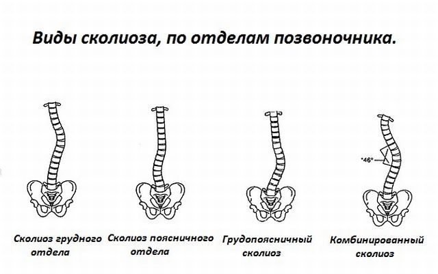 Højersidet skoliose i cervikal-, thorax- og lændehvirvelsøjlen