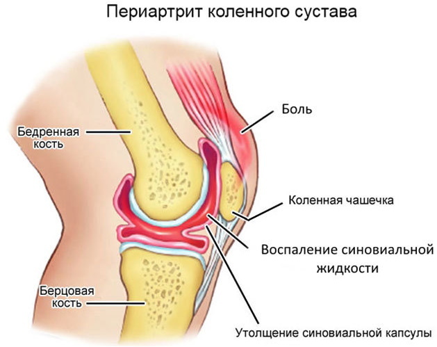Periartritis van het kniegewricht. Symptomen en behandeling van pezen