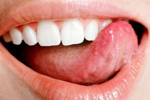 Degantis liežuvio galiukas. Priežastys ir gydymas