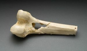 fibrotic osteodysplasia