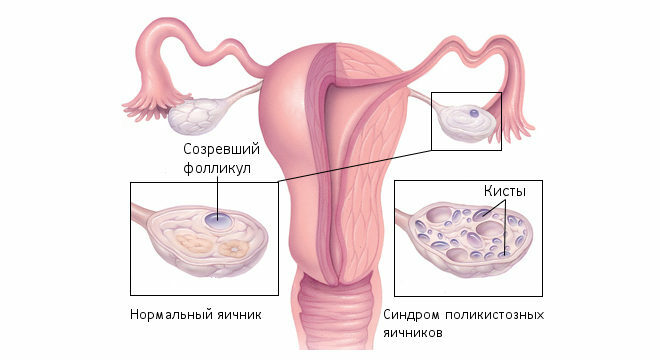 Dermoid ovariecyster