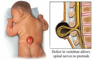 Treatment of spine pathologies