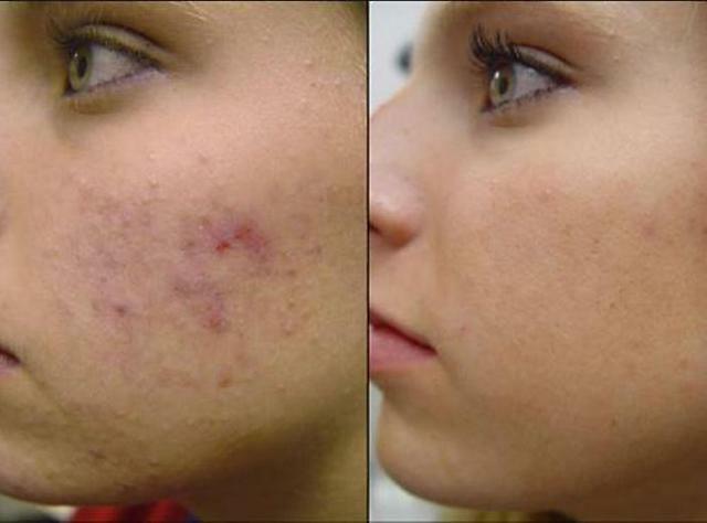 Elos-therapy. Before and after