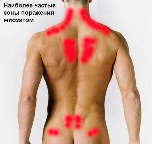 Zonas de miosite nas costas