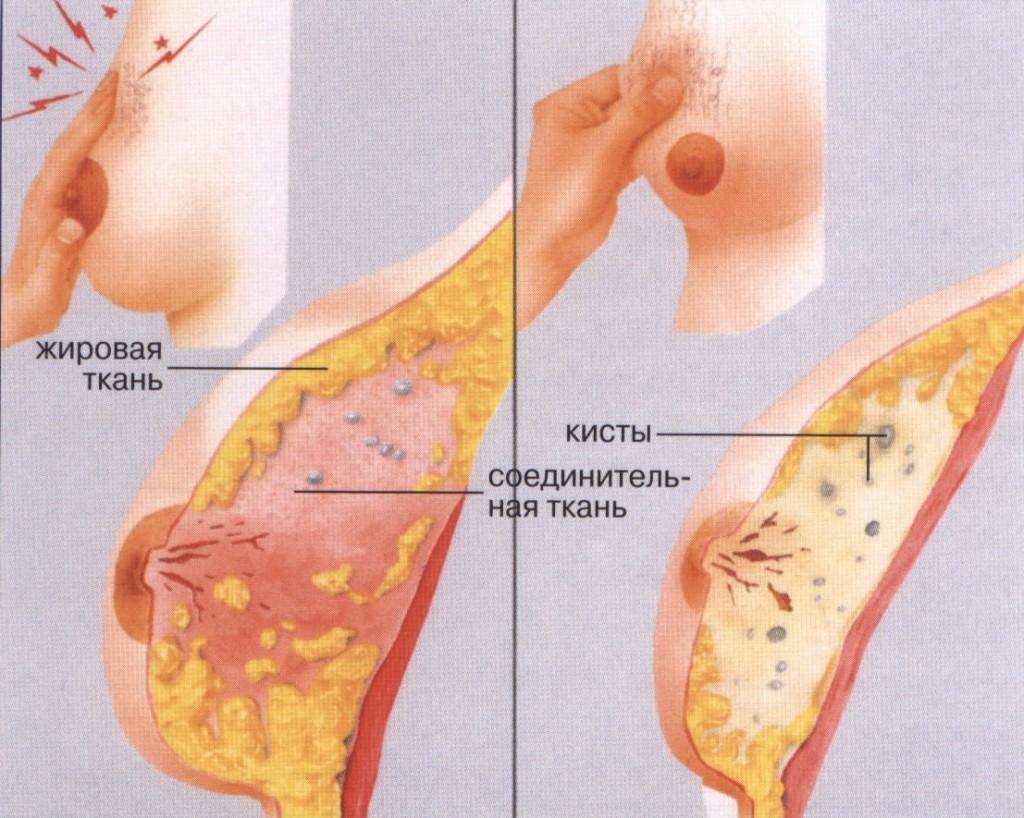 Mastopathy of mammary glands