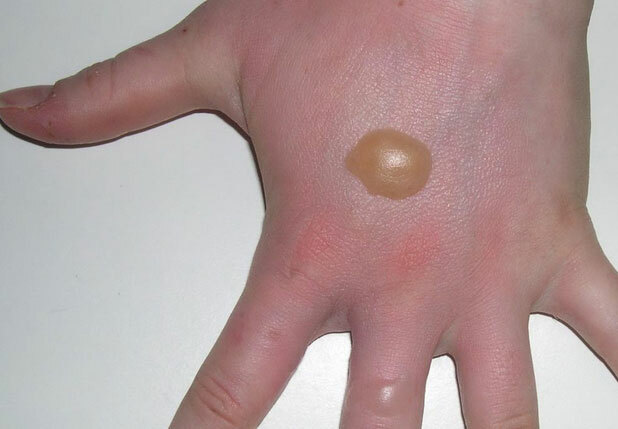 Blisteri uz pirkstiem - ārstēšana, ja ir nieze, cēloņi, foto