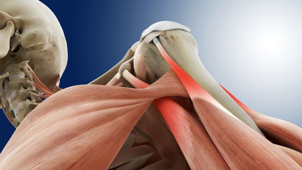 Rupture of the tendon of the supraspinatus muscle of the shoulder joint