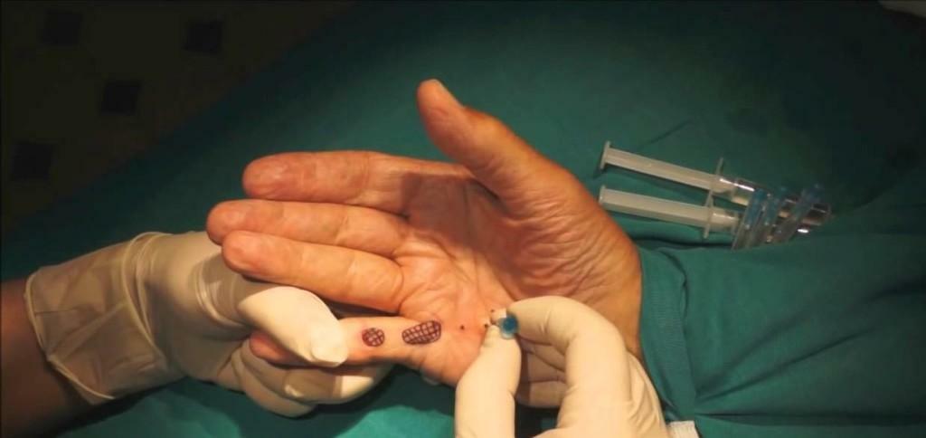 Dupuytren's contracture treatment - therapy and methods of surgery, the best techniques!