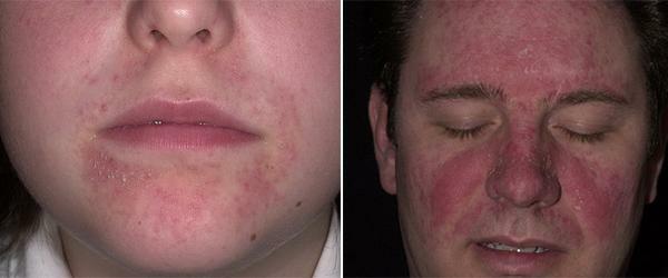 Treatment of dermatitis on the face in adults