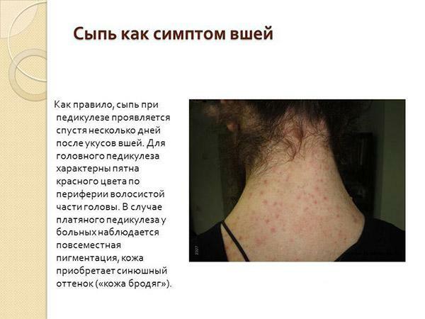 Rash as a symptom of lice