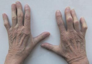 szeropozitív rheumatoid arthritis