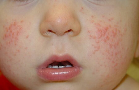 Simptomi škrlatne vročine pri otrocih
