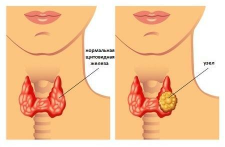 Nodurile hipoechoice de pe glanda tiroidă