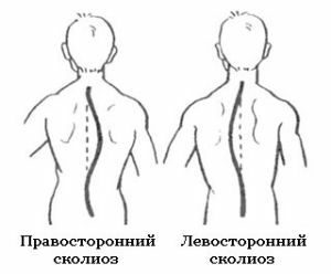 højre sidet og venstre sidet skoliose