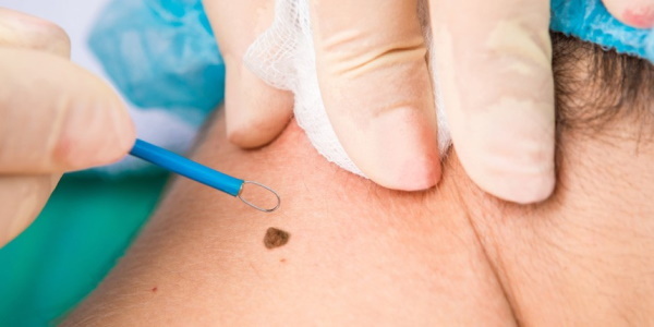 Removal of moles by electrocoagulation. How and how to treat the wound