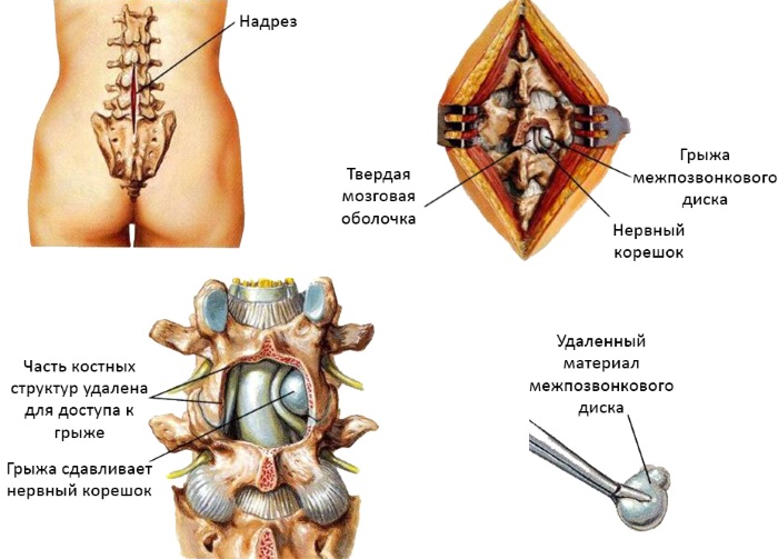 Sequestration of a herniated disc. What is it, symptoms, treatment
