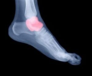 fracture of foot