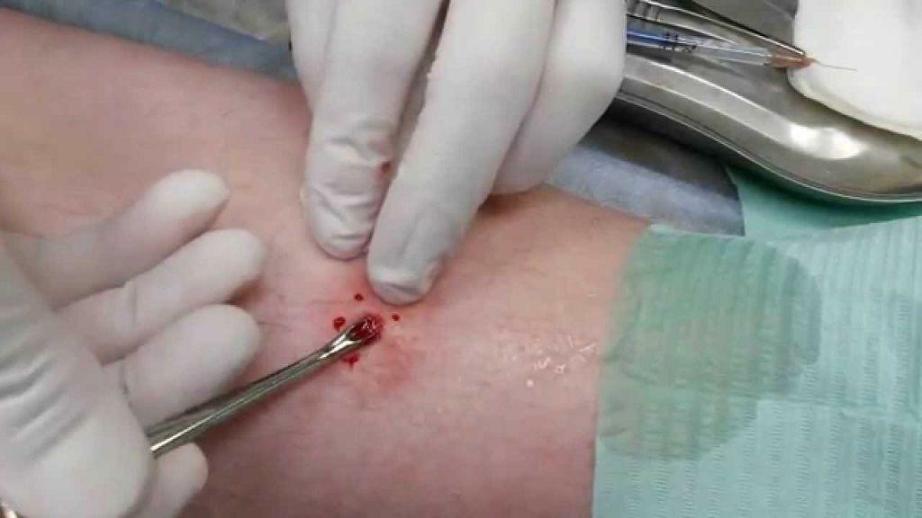 Surgical removal of the boil