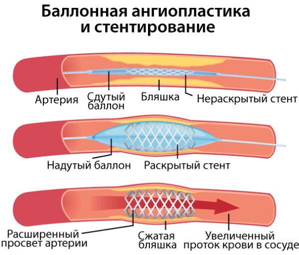 Aterosklerozė. Simptomai ir požymiai, kas yra ši liga