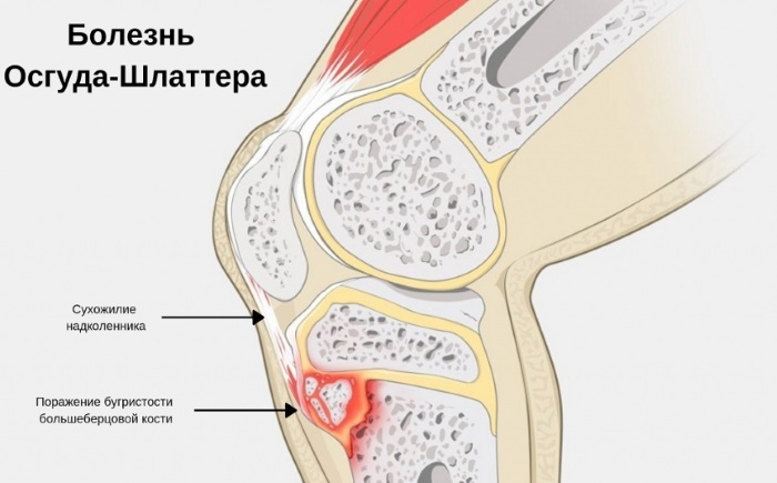 Osgood-Schlatter disease. X-ray, stages, description, treatment in adults, children, consequences