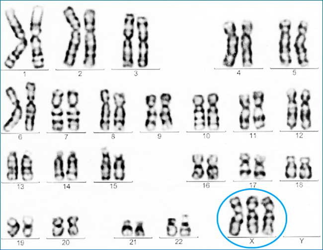 Trisomia sulla sindrome del cromosoma X. Cause, diagnosi, trattamento