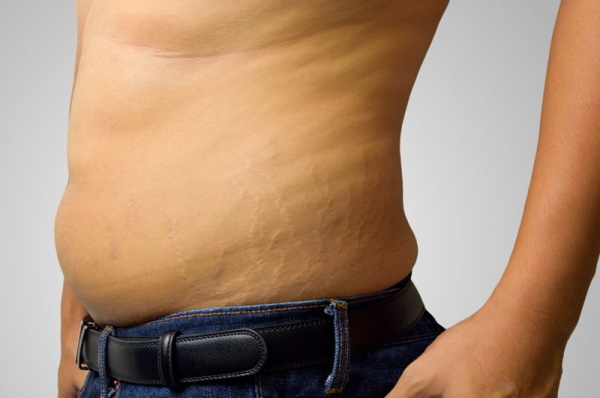 Celulitis en hombres en los costados, glúteos, abdomen, piernas. Foto