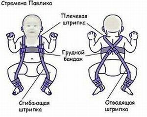 L'endurance de Pavlik est une méthode efficace pour combattre la dysplasie chez les enfants