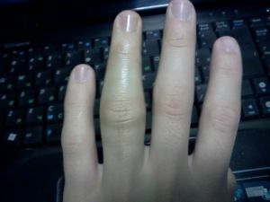 How to cure a strong bruise of the finger and not to provoke complications