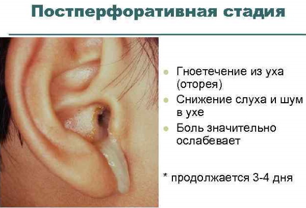 Como remover a água do ouvido após nadar, tomar banho, enxaguar o nariz