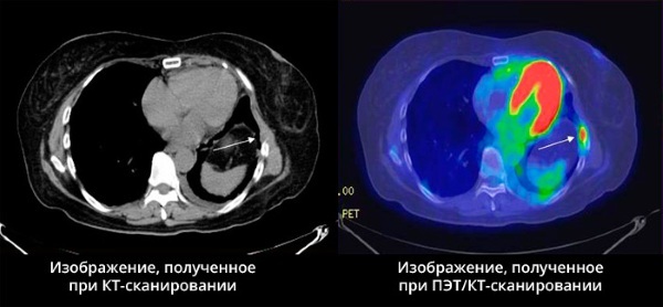 Dieta przed badaniem PET-CT z fluorodeoksyglukozą, środkiem kontrastowym, choliną