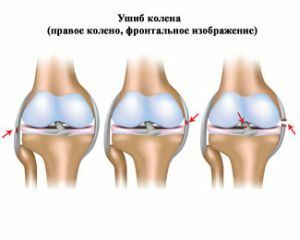 pravo poškodbo kolena
