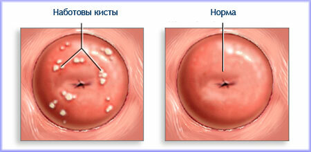 Nabotovy cyster i livmoderen