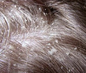Seborrhea of ​​the scalp