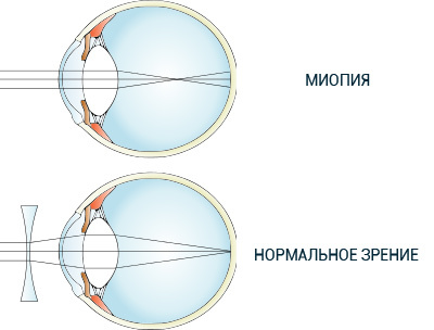 Myopia of medium degree: what is it?