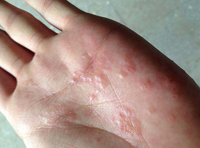 Cum de a vindeca eczeme pe mâini pentru totdeauna