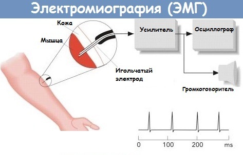 Az alsó végtagok EMG (elektromiográfia). Mi ez a felmérés